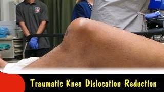 dislocated knee or patella [upl. by Ecirrehs695]