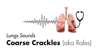 Coarse Crackles Rales  Lung Sounds  Medzcool [upl. by Aekal]