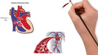 Pulmonary valve stenosis [upl. by Noirod324]