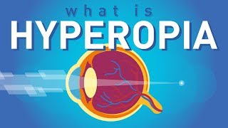 What is Hyperopia Farsightedness [upl. by Dianna]