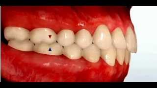 Class II Malocclusion [upl. by Nal377]