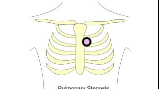 Pulmonary stenosis murmur [upl. by Brunn]