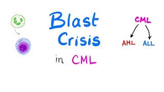 Blast Crisis in Chronic Myeloid Leukemia CML  When Chronic Myeloid Leukemia Goes Mad Hematology [upl. by Allmon]