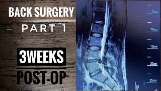 Back Surgery Laminectomy L4L5 Recovery part 1 [upl. by Asiar]