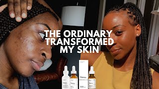 The Ordinary Skin Transformation Mandelic Acid Cleared My Acne  xoreni [upl. by Trix]