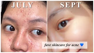 Rekomendasi Skincare utk Jerawat kombinasi berminyak [upl. by Helfant]