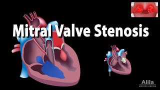 Mitral Valve Stenosis Animation [upl. by Ssilem]