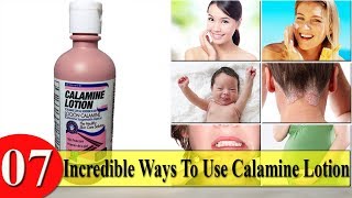 7 Incredible Ways To Use Calamine Lotion [upl. by Inavoig]