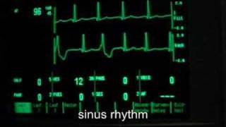 extrasystoles ventricular bigeminus [upl. by Ihcalam]