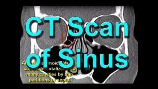 How To Read CT Sinus Scans Like An Expert [upl. by Kentiggerma759]