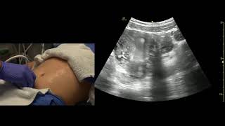 Transabdominal Pelvis Ultrasound Scanning Techniques [upl. by Alleras795]