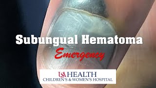 Subungual Hematoma Emergency and Trephination Procedure [upl. by Durrell]