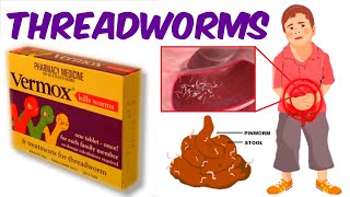 Threadworms  The Childhood Pinworm Infection Childhood Worms [upl. by Reilamag107]