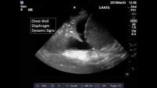 Lung and Pleural Ultrasound Interpretation [upl. by Slaby405]