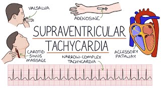 Understanding Supraventricular Tachycardia SVT [upl. by Alatea906]