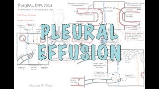 Pleural Effusion DETAILED  pathophysiology signs and symptoms treatment [upl. by Nnylf]