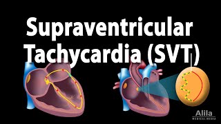 Supraventricular Tachycardia SVT PSVT Animation [upl. by Hnah]