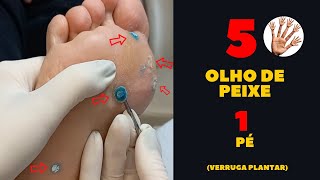 Olho de Peixe Verruga Plantar  SENSAÇÃO DE ALÍVIO 😅 [upl. by Wanyen732]