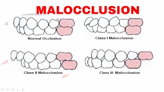 Malocclusion  Part I [upl. by Acinot604]