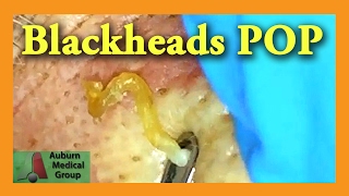 Blackheads POP  Auburn Medical Group [upl. by Nare]