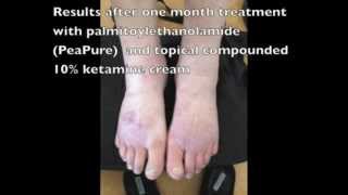 Palmitoylethanolamide and ketamine  Supplementary video 42417 [upl. by Krause939]