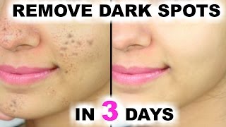 In 3 DAYS  Remove DARK SPOTS BLACK SPOTS amp ACNE SCARS  Anaysa [upl. by Thomasin]