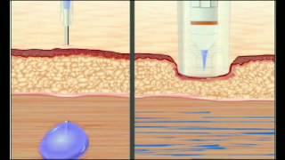 Needle VS Needle Free Injection [upl. by Rudolfo]