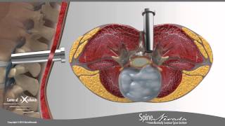 Lumbar Microdiscectomy  Spine Center Northern Nevada Northern California  Spine Surgery [upl. by Yspyg127]