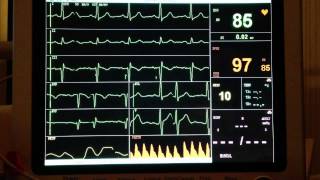 ECG  Extrasystole [upl. by Silisav487]