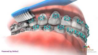 Life with Braces  Brushing amp Flossing [upl. by Absa]