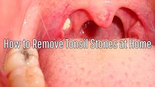 How to Remove Tonsil Stones at Home [upl. by Tamis]