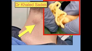 Neck Cyst Dr Khaled Sadek [upl. by Gilson]