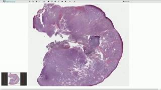 Mucosal Melanoma  Histopathology [upl. by Cordell]