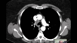 CT Chest Lung Nodule Discussed by Radiologist [upl. by Esinwahs788]