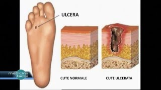 Medicina Facile  Curare il Piede diabetico [upl. by Stillman]