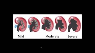 Hydronephrosis  Ultrasound [upl. by Enimsay205]