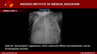 Respiratory Distress Syndrome in Neonates Hyaline Membrane Disease [upl. by Ahseikram274]