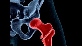 Bone Remodelling and Osteoporosis Endocrinologist Dr Janet Rubin MD [upl. by Miehar]