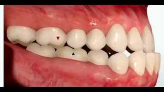 Class III Malocclusion [upl. by Bernita]