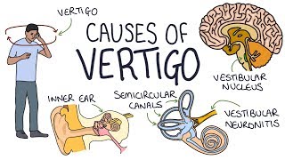 Vertigo Treatment  Epley Maneuver  American Academy of Neurology [upl. by Tillfourd]