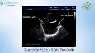 099 Eustachian Valve Crista Terminalis [upl. by Thaddus]