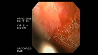 Esophagogastroduodenoscopy [upl. by Arza]