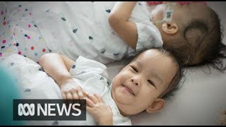 Dying To Be Apart Conjoined Twins Documentary  Real Stories [upl. by Banwell]