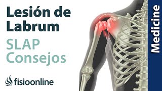 Consejos para solucionar la lesión labrum de hombro SLAP [upl. by Nagyam]