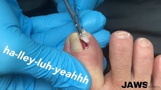 REMOVING A LARGE INGROWN TOENAIL [upl. by Lombardo]