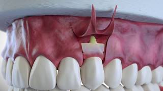 Subepithelial Connective Tissue Grafting [upl. by Nyloc]