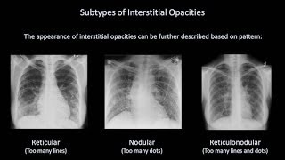 How to Interpret a Chest XRay Lesson 7  Diffuse Lung Processes [upl. by Vijar]