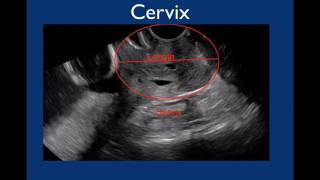 Pelvic Ultrasound [upl. by Wanids]