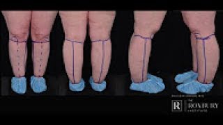 Lymphedema Symptoms and Treatments [upl. by Merell]