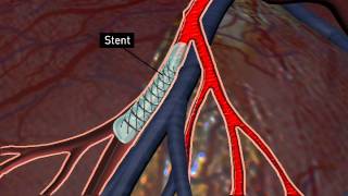 Carotid Stenting and Endarterectomy [upl. by Asta]